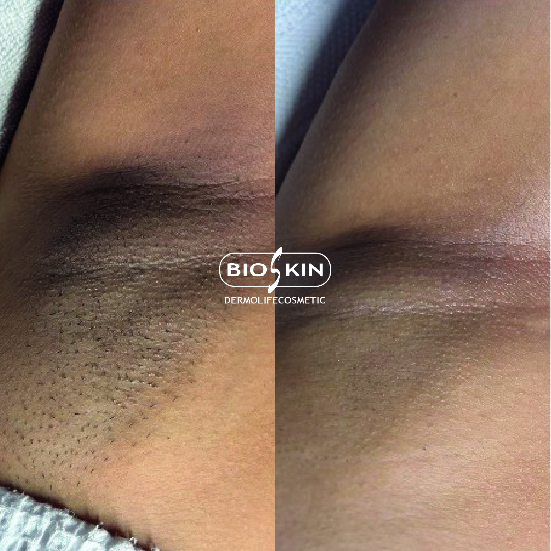 BSK204 INTIM WHITENING PRO KIT - Imagen 3